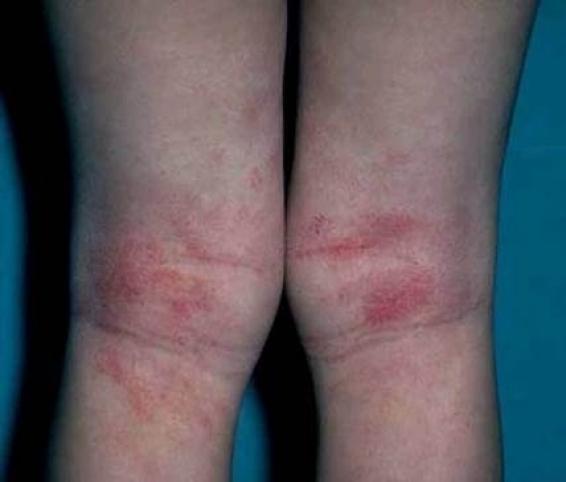 Dermatitis atópica 